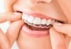 clear aligners